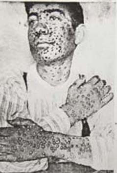 otm_vlc_ 19th century smallpox victim.jpg